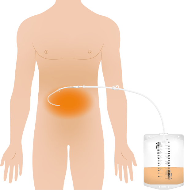 Illustration Aszites mit Schwerkraftreservoir