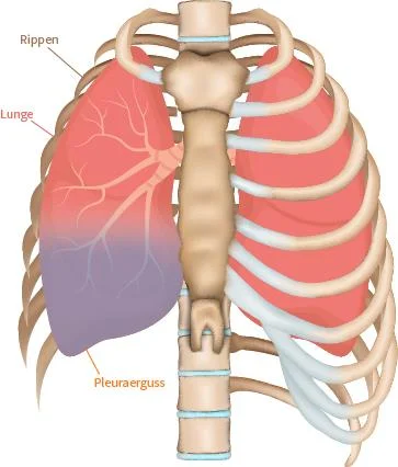 Illustration der Lunge bei einem Pleuraerguss